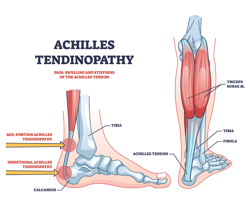 Achilles Tendinopathy