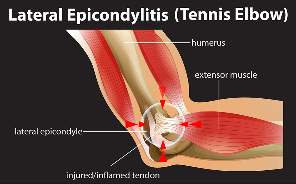 Lateral Epicondylitis Tennis Elbow