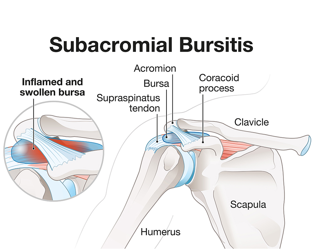 Subacromial bursitis