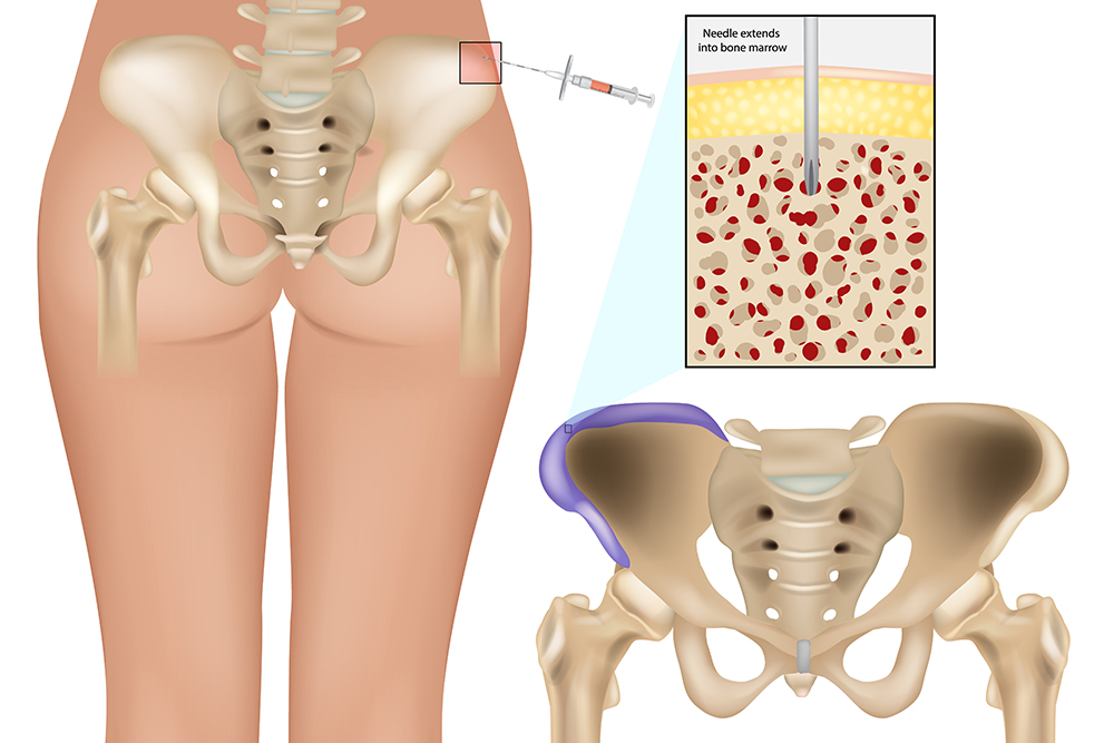Bone Marrow Stemcell therapy
