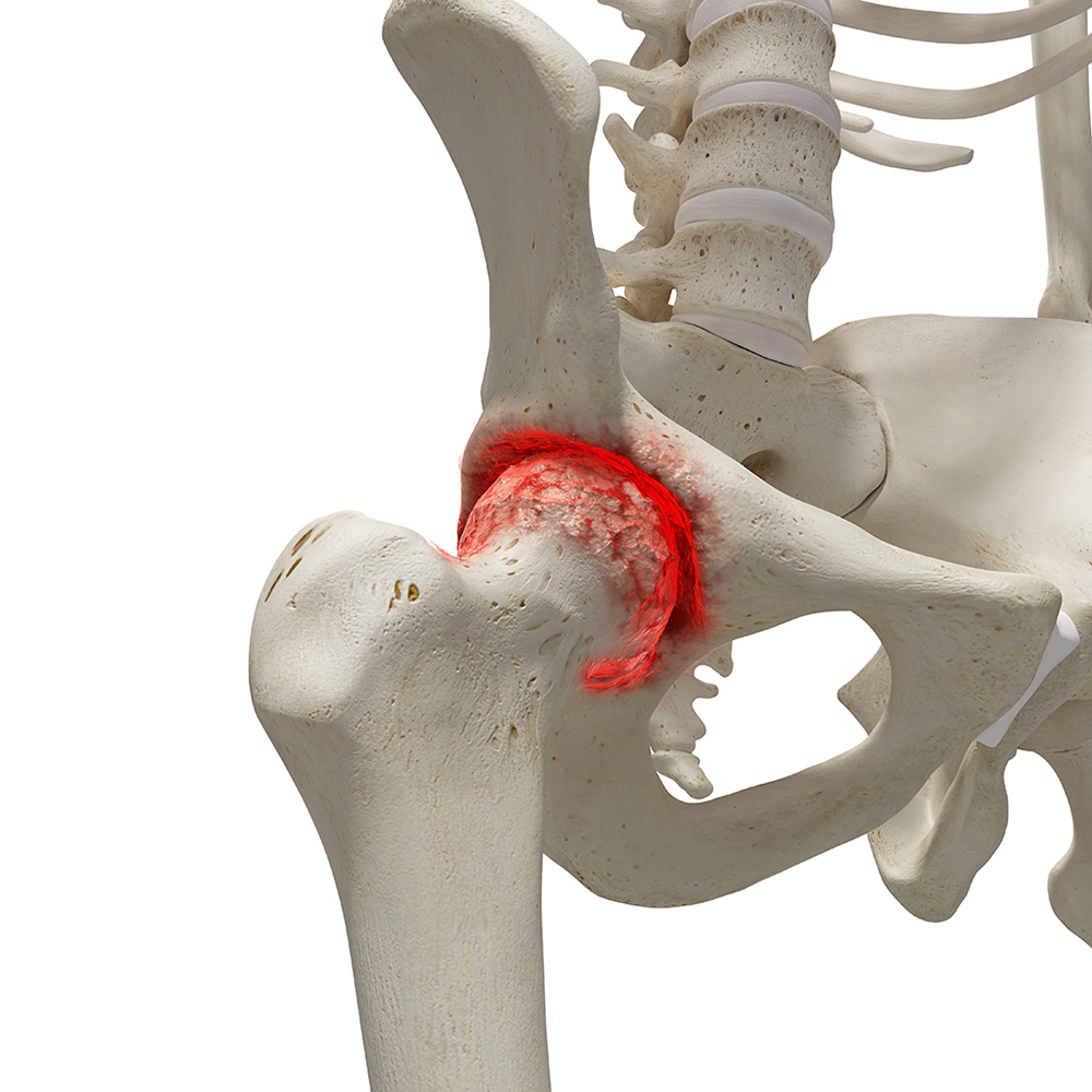HIP Arthritis Joint Pain