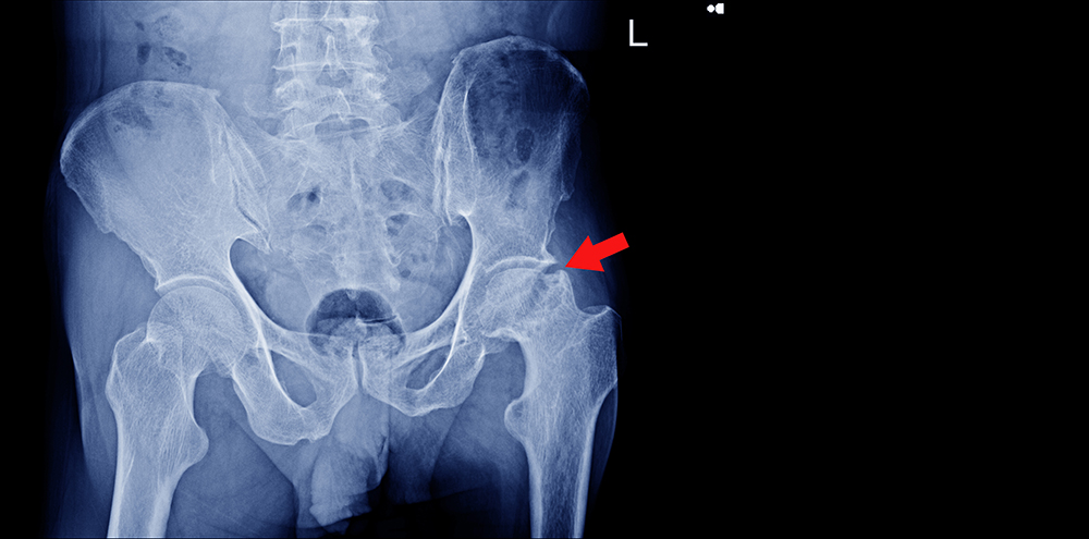 HIP Arthritis XRAY