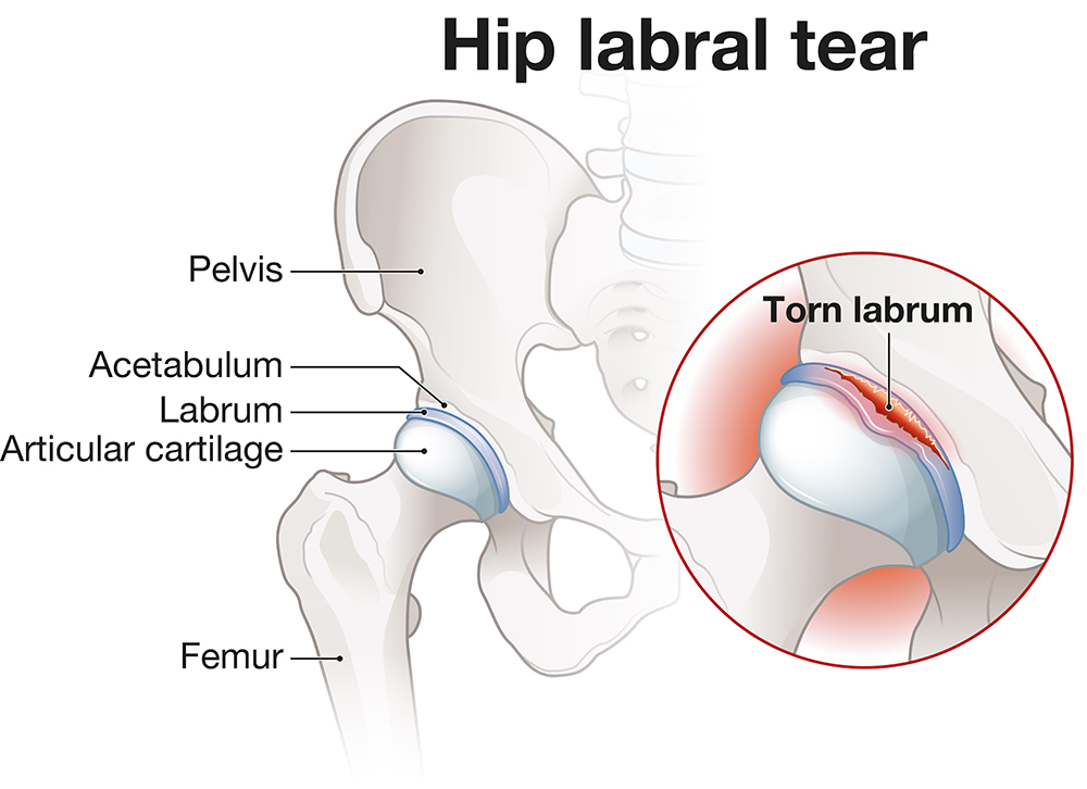 Hip Labral Tear
