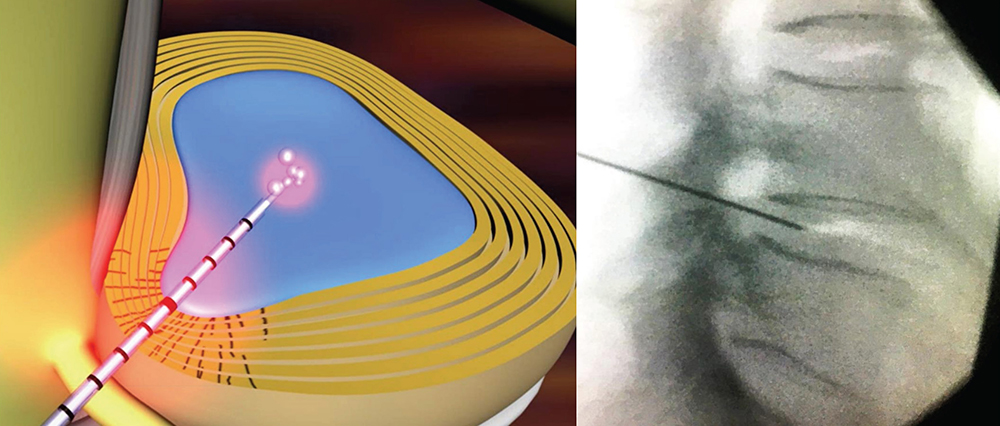 Intradiscal Procedures GE OEC 9900 Elite imaging