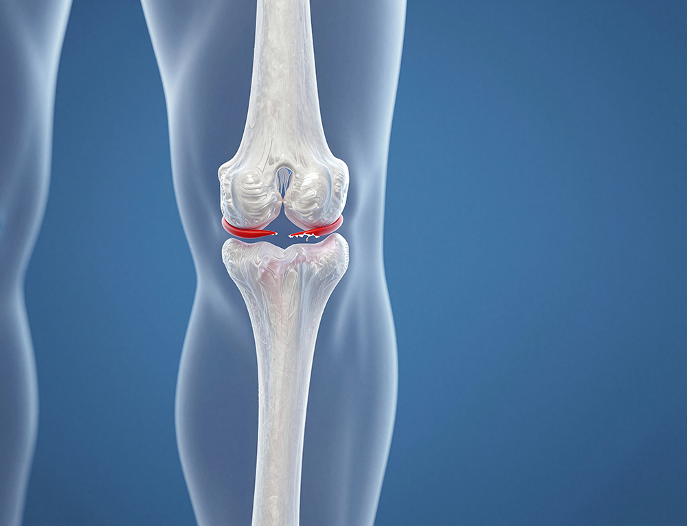 Knee Pain