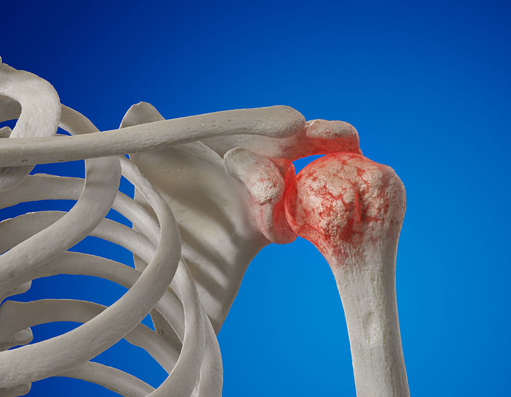 Shoulder Arthritis