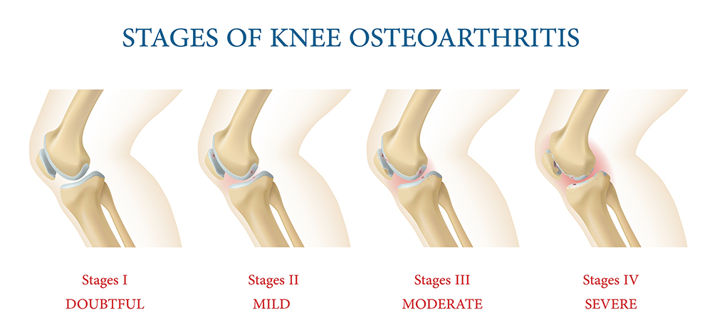 Stages of Knee Arthritis