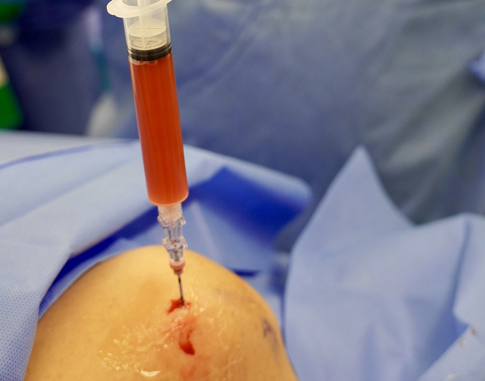 Knee pain injection supervised by experienced doctor