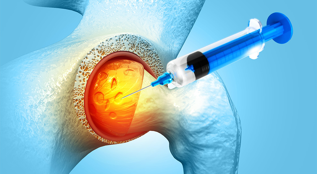 Hip Osteoarthritis