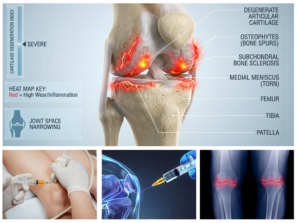 Knee pain and Stemcell therapy